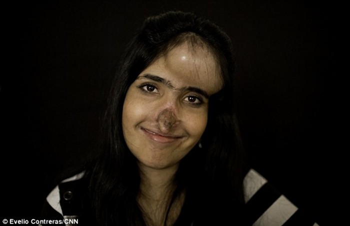 Афганской девушке сделали новый нос